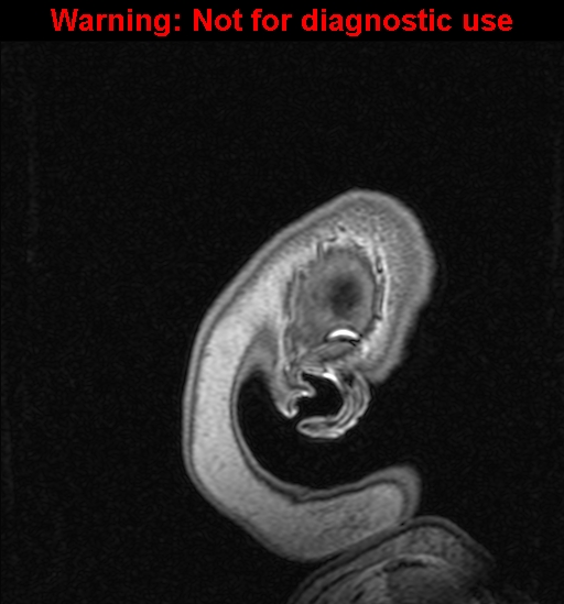 Cerebral venous thrombosis (Radiopaedia 37224-39208 Sagittal T1 C+ 151).jpg