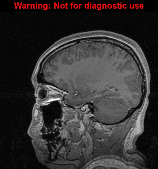 File:Cerebral venous thrombosis (Radiopaedia 37224-39208 Sagittal T1 C+ 51).jpg