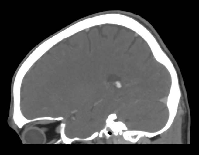 Cerebral venous thrombosis (Radiopaedia 38392-40467 D 36).png