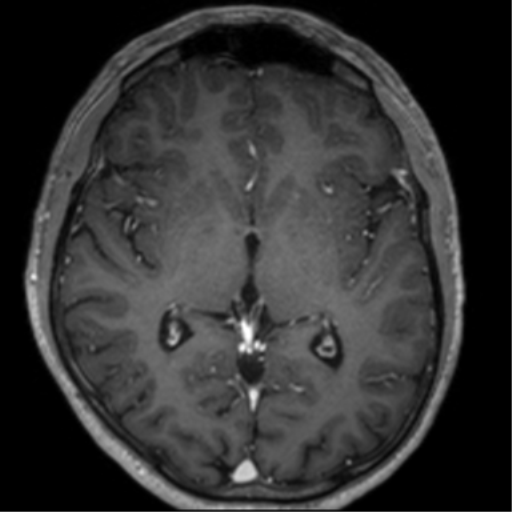 Cerebral venous thrombosis (Radiopaedia 38392-40469 Axial T1 C+ 41).png