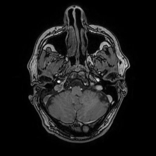 File:Cerebral venous thrombosis with secondary intracranial hypertension (Radiopaedia 89842-106957 Axial T1 C+ 47).jpg