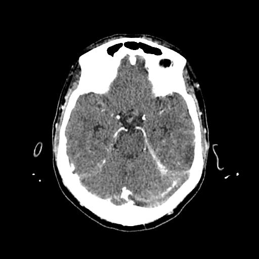 Cerebral venous thrombosis with venous hemorrhagic infarct (Radiopaedia 90354-107660 Axial with contrast 61).jpg