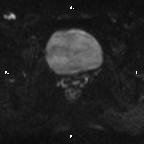 File:Cervical adenocarcinoma (Radiopaedia 65011-73985 Axial DWI 32).jpg