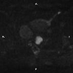 Cervical adenocarcinoma (Radiopaedia 65011-73985 Axial DWI 42).jpg