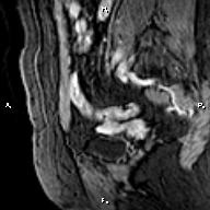 File:Cervical adenocarcinoma (Radiopaedia 65011-73985 E 3).jpg