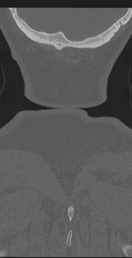 Cervical canal stenosis due to ossification of the posterior longitudinal ligament (Radiopaedia 47260-51823 Coronal bone window 74).png