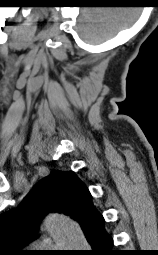 Cervical canal stenosis due to ossification of the posterior longitudinal ligament (Radiopaedia 47260-51823 D 15).png