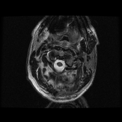 File:Cervical canal stenosis with cord compression (Radiopaedia 34114-35374 Axial T2 34).png