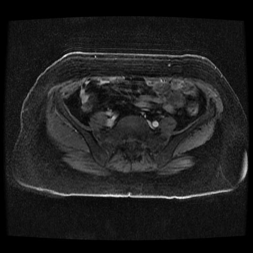 File:Cervical carcinoma (Radiopaedia 70924-81132 Axial T1 C+ fat sat 164).jpg