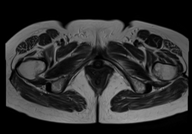 File:Cervical carcinoma (Radiopaedia 88312-104943 Sagittal T1 20).jpg