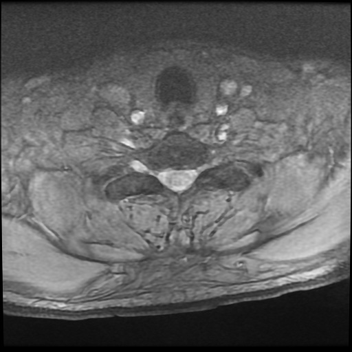 Cervical disc extrusion (Radiopaedia 59074-66364 F 53).jpg