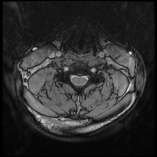 Cervical disc extrusion (Radiopaedia 59074-66364 G 47).jpg