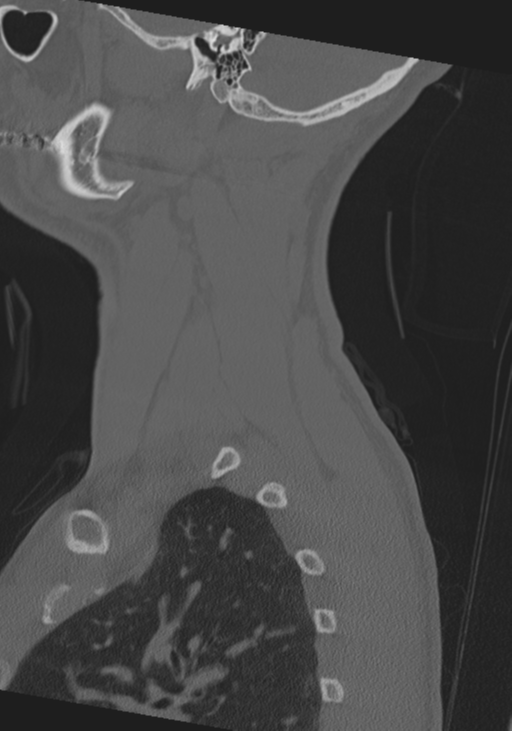 Cervical intercalary bone (Radiopaedia 35211-36748 Sagittal bone window 70).png