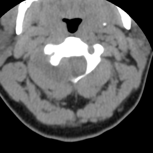Cervical schwannoma (Radiopaedia 57979-64974 Axial non-contrast 20).png