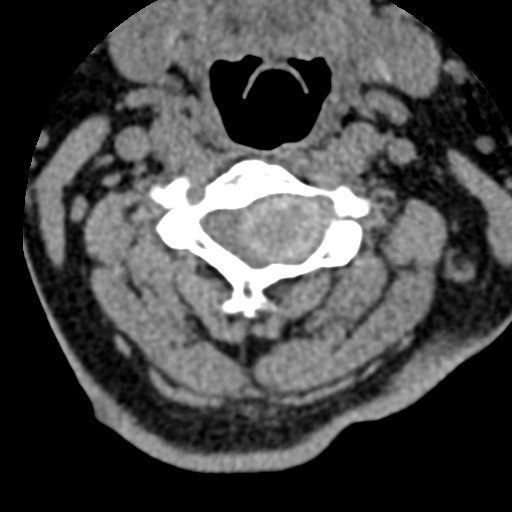 File:Cervical spinal neurofibroma in a patient with NF1 (Radiopaedia 58344-65464 Axial non-contrast 32).jpg