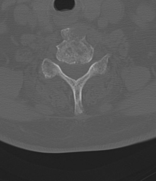 Cervical spine fracture in the setting of ankylosis (Radiopaedia 37038-38715 Axial bone window 44).png