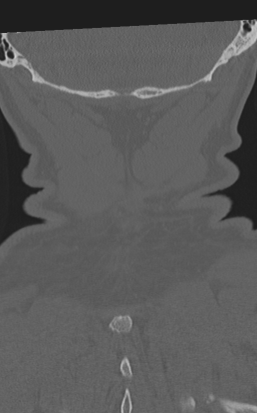 Cervical spine fractures with vertebral artery dissection (Radiopaedia 53296-59268 Coronal bone window 65).png