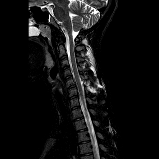File:Cervical spine posterior ligamentous complex rupture (Radiopaedia 63486-72103 Sagittal STIR 8).jpg