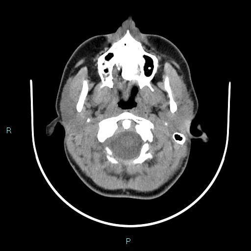 File:Cervical thymic cyst (Radiopaedia 88632-105335 Axial non-contrast 98).jpg