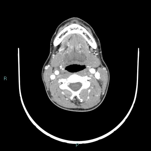 Cervical thymic cyst (Radiopaedia 88632-105335 B 69).jpg