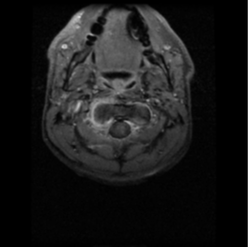 File:Cervical vertebrae metastasis (Radiopaedia 78814-91667 Axial T1 C+ fat sat 9).png