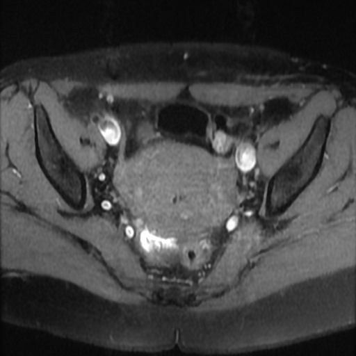 File:Cesarian section scar endometriosis (Radiopaedia 66520-75799 Axial T1 fat sat 12).jpg