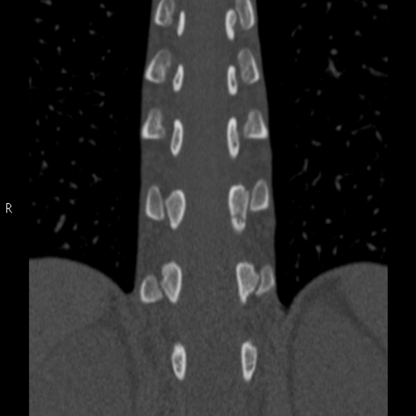 Chance fracture (Radiopaedia 36521-38081 Coronal bone window 36).jpg