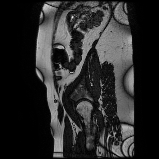 Chiari II malformation - fetal MRI (Radiopaedia 68099-77581 Sagittal Fiesta 53).jpg