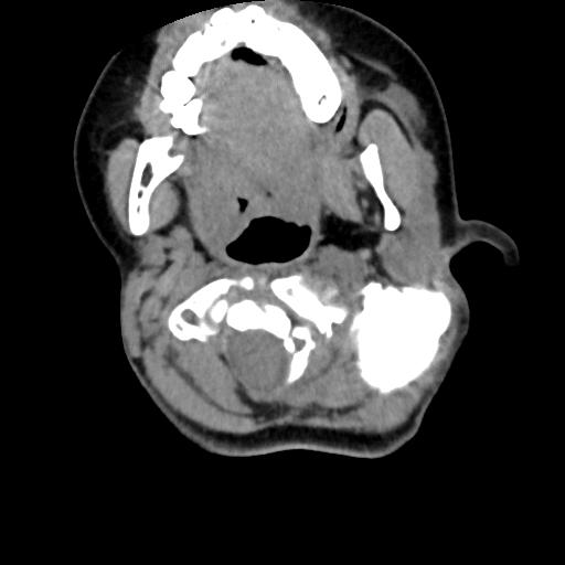 Chiari I with syrinx and skull base anomalies (Radiopaedia 89444-106412 Axial non-contrast 53).jpg