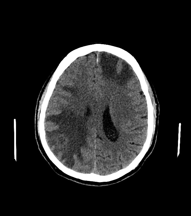 Cholangiocarcinoma with cerebral metastases (Radiopaedia 83519-98628 Axial non-contrast 43).jpg