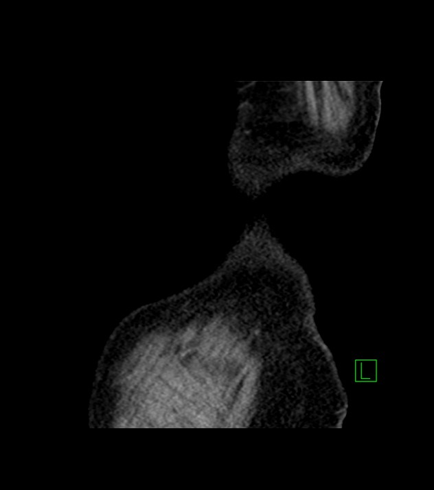 Cholangiocarcinoma with cerebral metastases (Radiopaedia 83519-98629 Sagittal C+ delayed 108).jpg