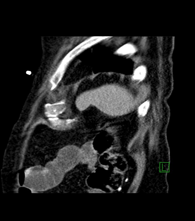 Cholangiocarcinoma with cerebral metastases (Radiopaedia 83519-98629 Sagittal C+ delayed 13).jpg
