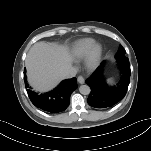 Cholecystitis with focal perforation and hepatic abscess (Radiopaedia 37189-38945 Axial non-contrast 10).png