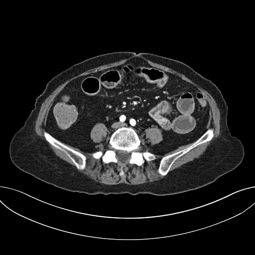 File:Cholecystoduodenal fistula due to calculous cholecystitis with gallstone migration (Radiopaedia 86875-103077 A 45).jpg