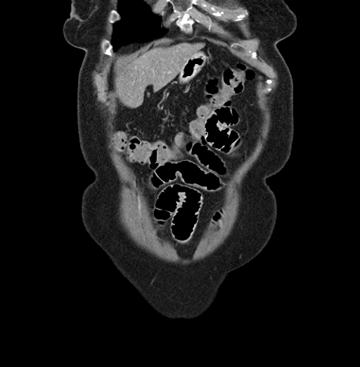 File:Cholecystoduodenal fistula due to calculous cholecystitis with gallstone migration (Radiopaedia 86875-103077 B 8).jpg