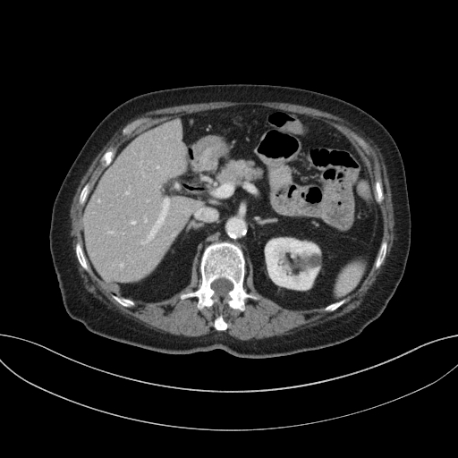 Cholecystoduodenal fistula due to calculous cholecystitis with gallstone migration (Radiopaedia 86875-103077 D 30).jpg