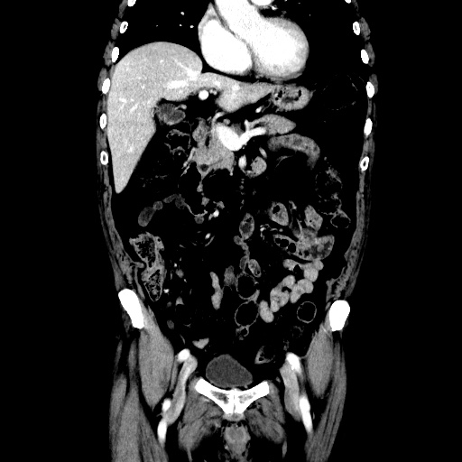 Choledocholiathiasis with normal caliber common bile duct (Radiopaedia 75368-86632 Coronal liver window 53).jpg