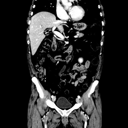 Choledocholiathiasis with normal caliber common bile duct (Radiopaedia 75368-86632 Coronal liver window 58).jpg