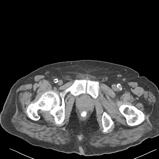 File:Choledocholithiasis and gastric polyp (Radiopaedia 48856-53895 Axial non-contrast 88).png