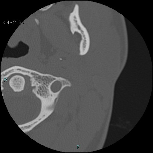 Cholesterol granuloma of the petrous apex (Radiopaedia 64358-73141 Axial bone window 104).jpg