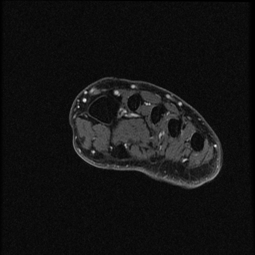 File:Chondroblastoma - midfoot (Radiopaedia 64831-73765 G 24).jpg