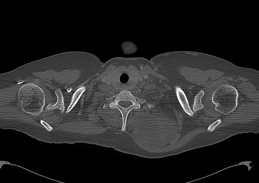 File:Chondrosarcoma - chest wall (Radiopaedia 65192-74199 Axial bone window 7).jpg