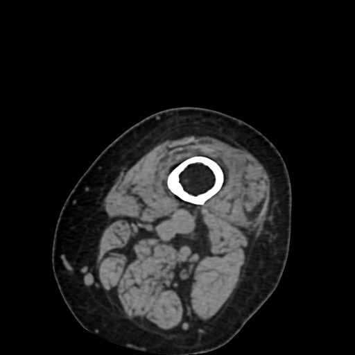 Chondrosarcoma - femur (Radiopaedia 64187-72954 Axial non-contrast 1).jpg