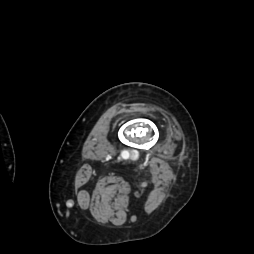File:Chondrosarcoma - femur (Radiopaedia 64187-72954 Axial with contrast 13).jpg