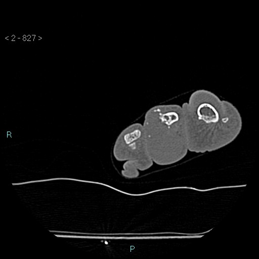 Chondrosarcoma - phalanx (Radiopaedia 69047-78812 Axial bone window 81).jpg