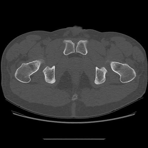File:Chondrosarcoma of iliac wing (Radiopaedia 63861-72599 Axial bone window 115).jpg