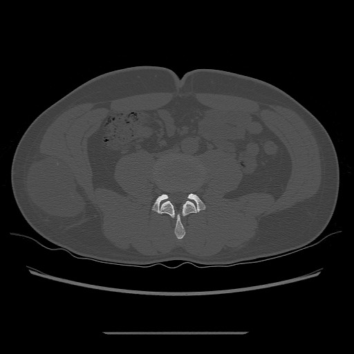 File:Chondrosarcoma of iliac wing (Radiopaedia 63861-72599 Axial bone window 16).jpg