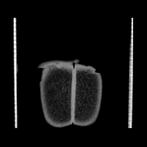 Chondrosarcoma of iliac wing (Radiopaedia 63861-72599 Coronal non-contrast 116).jpg