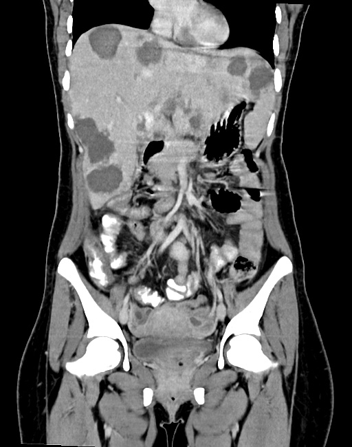 Choriocarcinoma liver metastases (Radiopaedia 74768-85766 B 48).jpg
