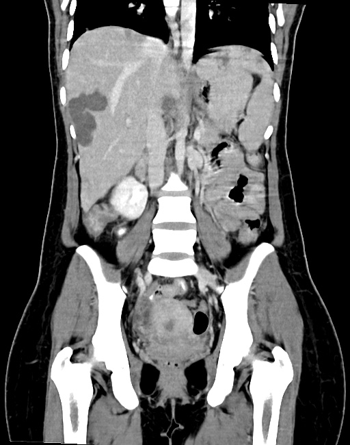 Choriocarcinoma liver metastases (Radiopaedia 74768-85766 B 59).jpg